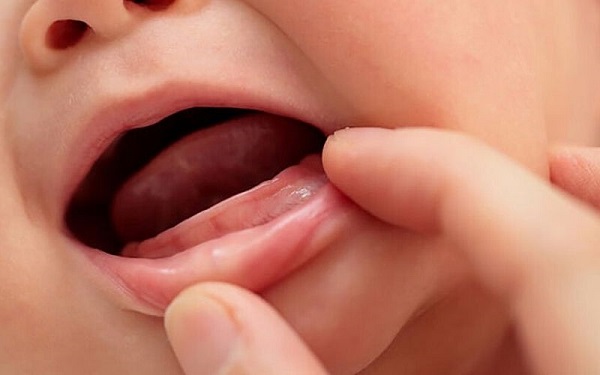 Như thế nào được xem là trẻ chậm mọc răng?